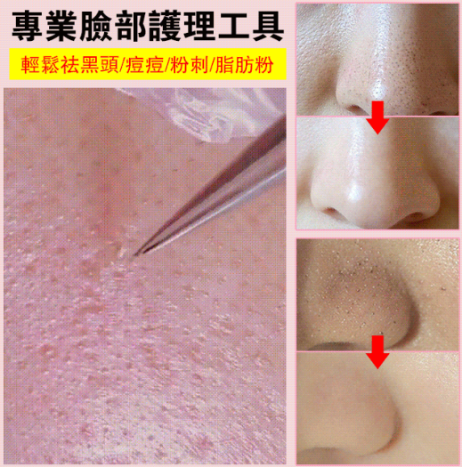 不銹鋼粉刺黑頭夾火爆熱銷中!官方正品,免費試用,台灣出貨!24小時在線客服,不好用直接退!售後無憂! 不銹鋼粉刺黑頭夾火爆熱銷中!官方正品,免費試用,台灣出貨!24小時在線客服,不好用直接退!售後無憂!